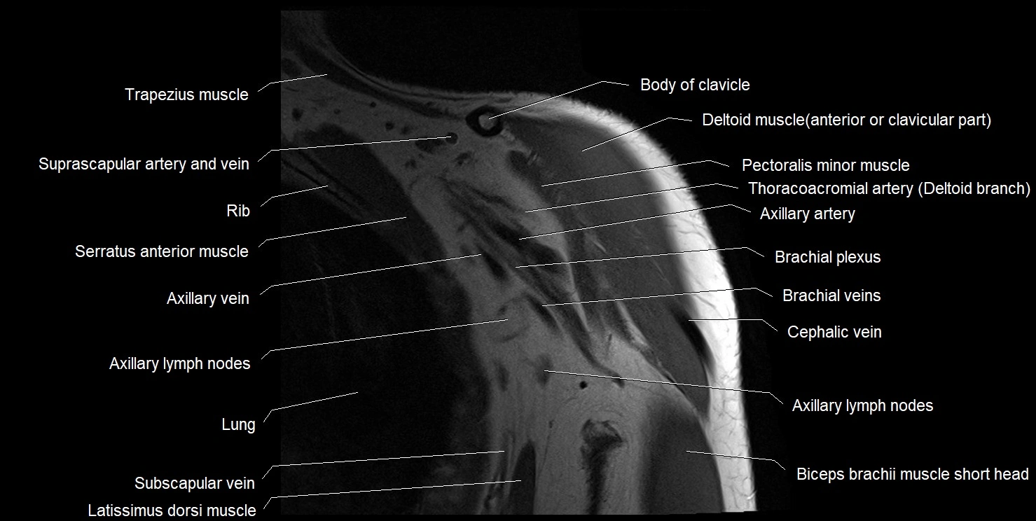 mri shoulder coronal cross sectional anatomy image 2.webp